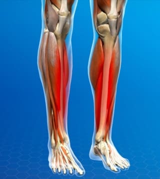 Shin Splints: A Helpful Guide | Causes, Symptoms, and Treatments ...